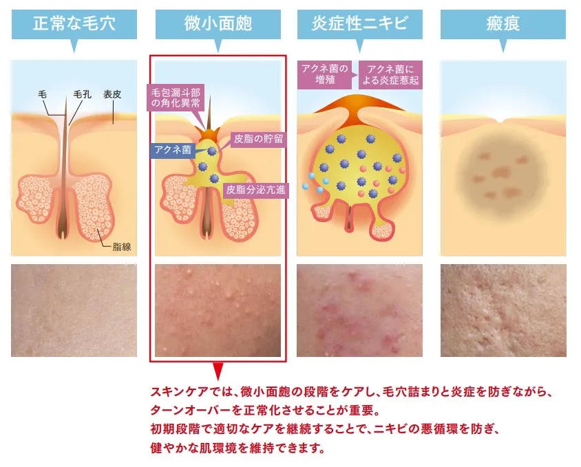 毛穴の詰まりからニキビ、瘢痕へと至るメカニズムの解説図